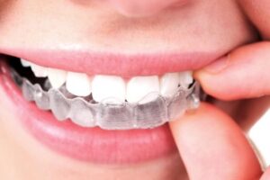 Woman Putting Invisalign Aligners | 303 Smiles