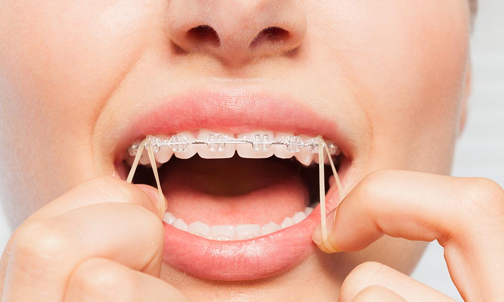 Rubber Band Tips for Braces Wearers